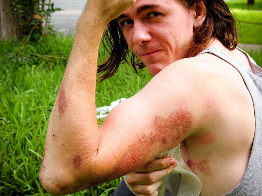 Abrasion